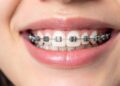 Clear Braces vs Metal Braces
