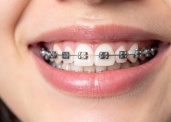 Clear Braces vs Metal Braces
