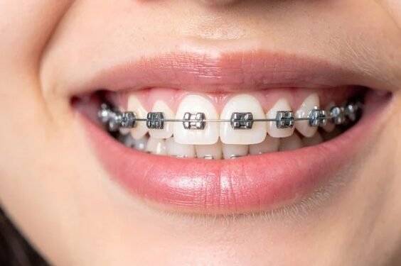 Clear Braces vs Metal Braces