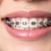 Clear Braces vs Metal Braces