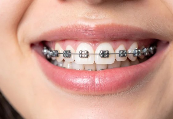 Clear Braces vs Metal Braces