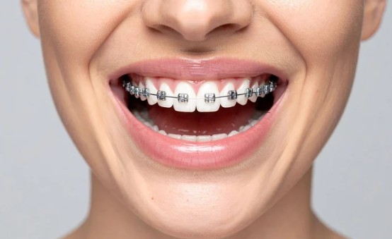 Metal Braces Smaller but Noticeable